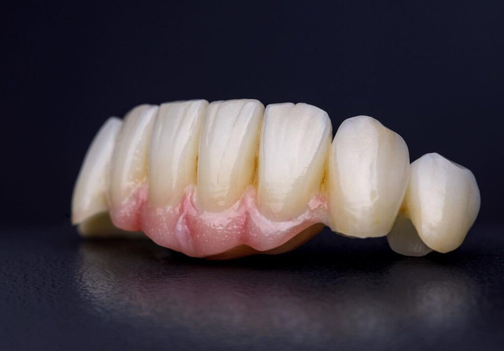 Имплантация зубов Планерная